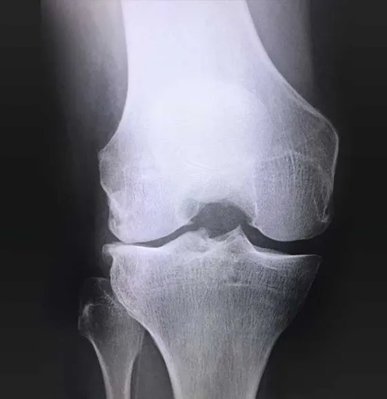 50代以上の女性の方必見　変形性膝関節症の痛みを解消させる